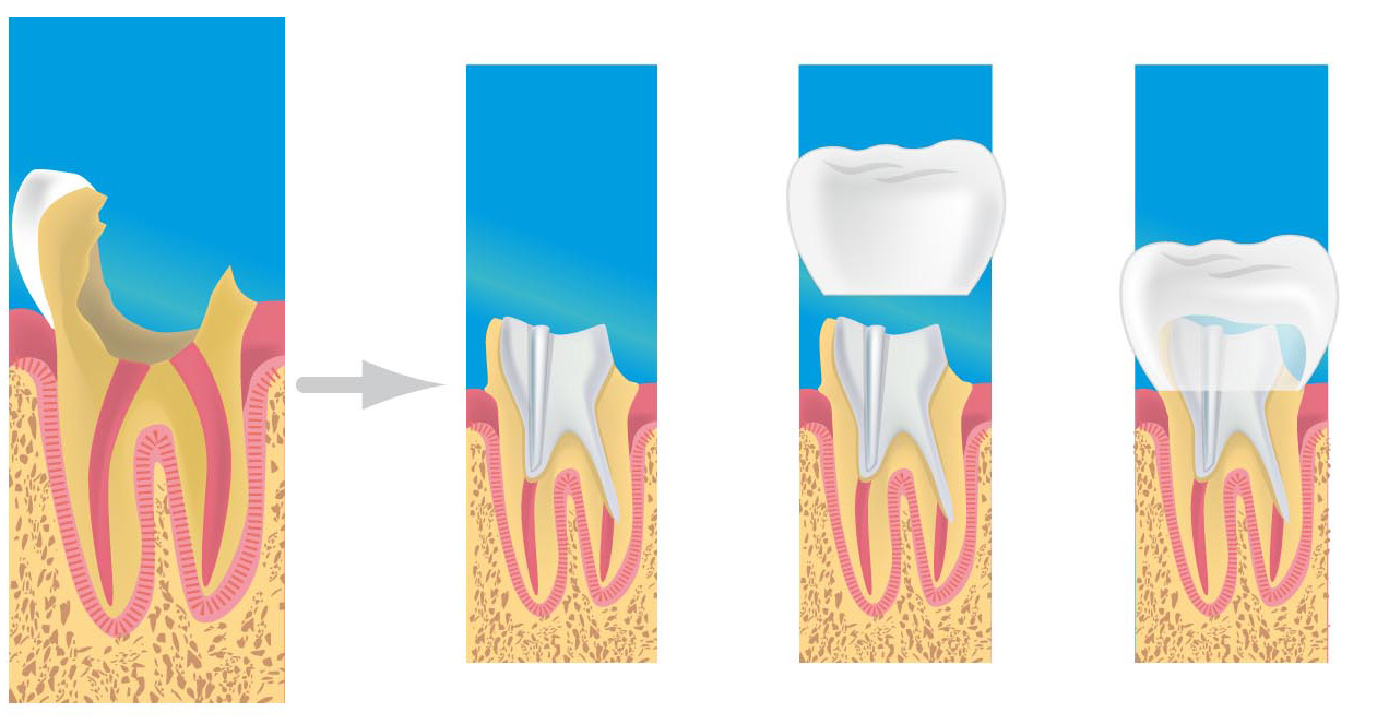 prothese dentaire massy couronne bridge