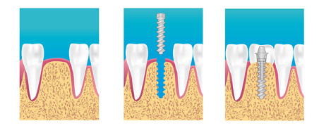 photo Implants dentaires à Massy 91